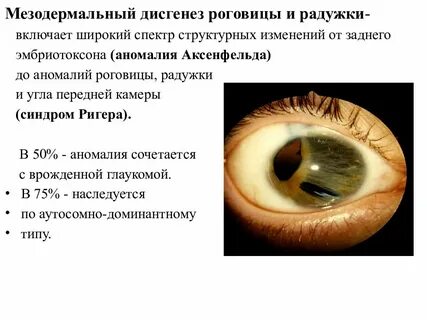 Аномалия роговицы