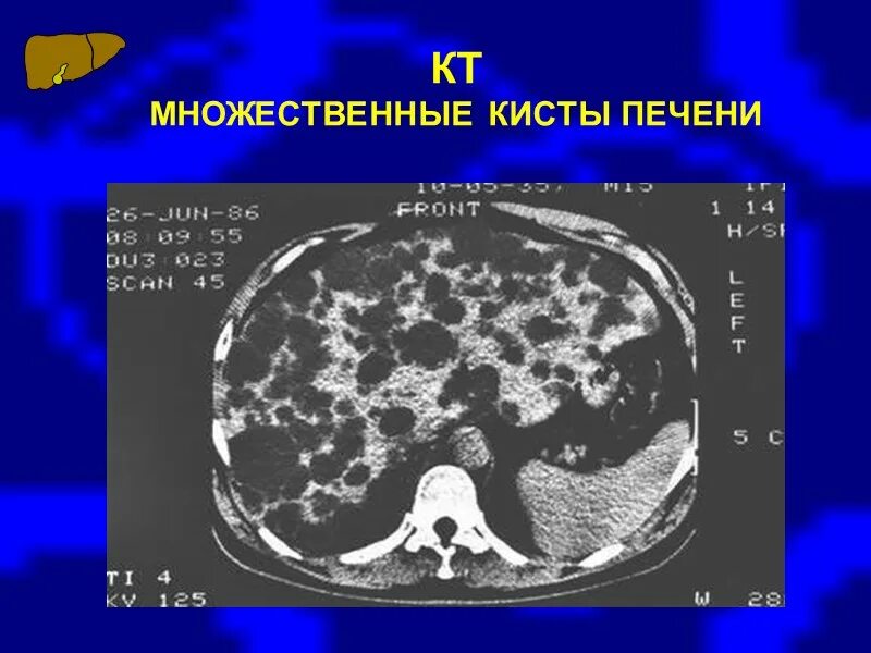 Киста печени причины возникновения у женщин. Множественные кисты печени. Множественные кистозные образования печени кт. Множественные мелкие кисты печени. Многочисленные кисты в печени.