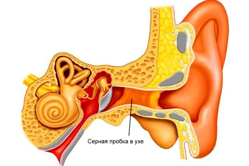 Почему возникает пробка в ухе. Тубоотит барабанная перепонка. Серная пробка наружного слухового прохода. Наружный отит серная пробка.