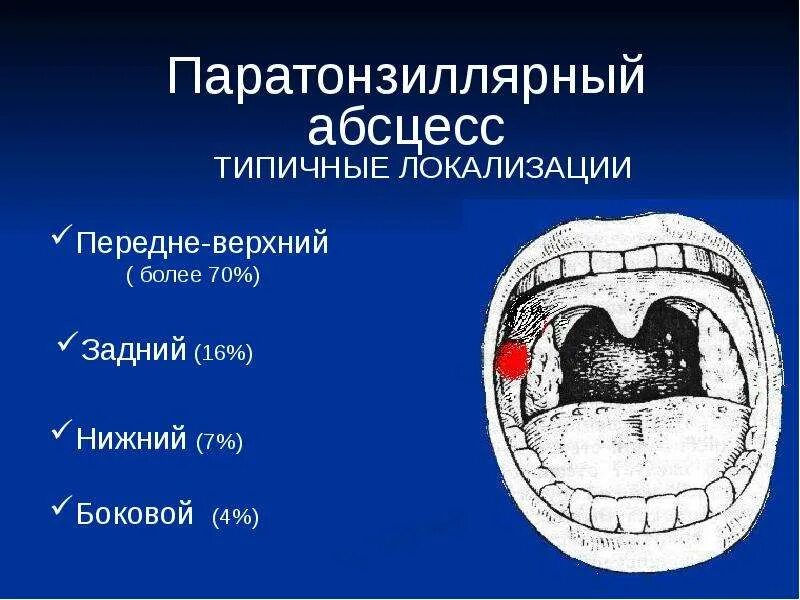 Абсцесс карта вызова. Паратонзиллярный абсцесс презентация. Симптомы паратонзиллярного абсцесса. Паратонзиллярный абсцесс вскрытие. Задний паратонзиллярный абсцесс.