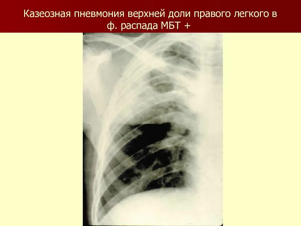 Фаза распада легких. Казеозная пневмония туберкулез рентген. Ацинозная казеозная пневмония. Казеозная пневмония рентгенограмма.