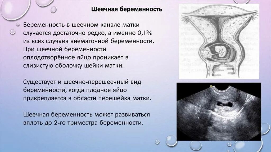 Эктопическая шеечная беременность. Внематочная беременность. При внематочной беременности. Формы внематочной беременности. Удалили трубу можно ли забеременеть