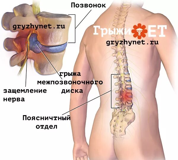 Грыжа поясничного отдела лечение у мужчин симптомы. Межпозвоночная грыжа поясничного отдела симптомы. Грыжа пояснично-крестцового отдела. Грыжа позвоночника симптомы пояснично-крестцовый. Позвоночник с грыжей в пояснице.