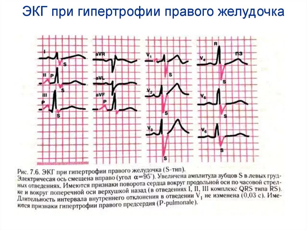 ЭКГ синдром гипертрофии желудочков. S Тип гипертрофии правого желудочка на ЭКГ. ЭКГ пленка с гипертрофией правого желудочка. Правожелудочковая гипертрофия ЭКГ. Экг преобладание левого желудочка