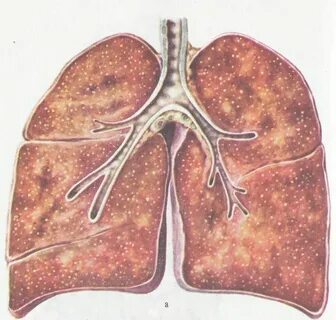 Tuberculosis