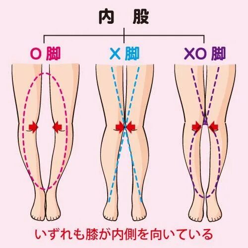 Йога для исправления кривизны ног. O leg o