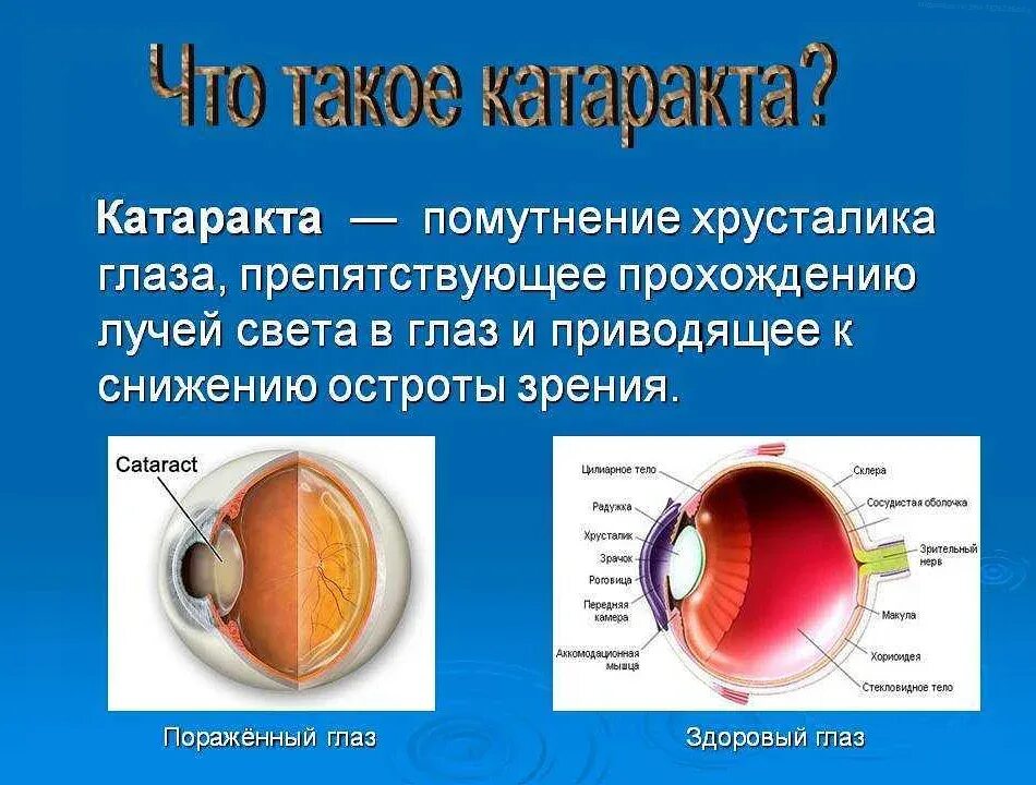 Катаракта это простыми словами