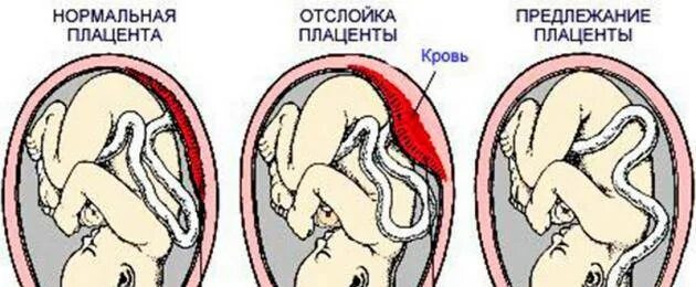 Отслойка хориона на ранних сроках. Отслойка плаценты на 7 месяце. Отслойка плаценты на 7 неделе.