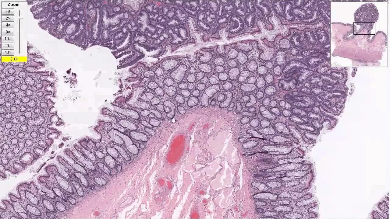 тубулярная аденома толстой кишки гистология. дисплазия эпителия гистология. тубулярные аденомы толстой кишки. дисплазия желудка гистология. интраэпителиальная неоплазия высокой степени толстой кишки.