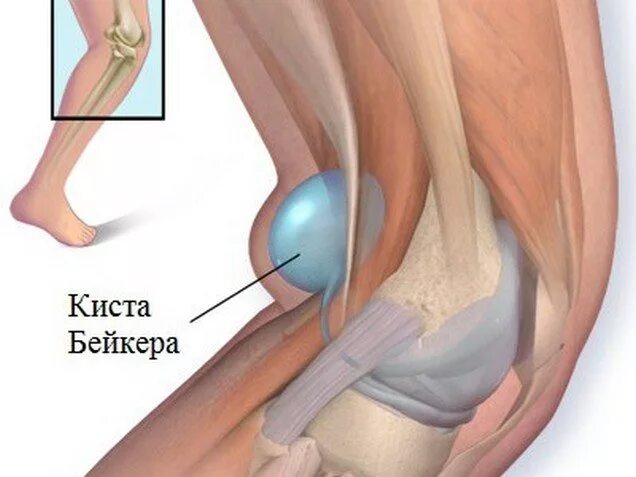 Болит под коленкой. Подколенная грыжа Бехтерева. Киста подколенной ямки (Бехтерева).