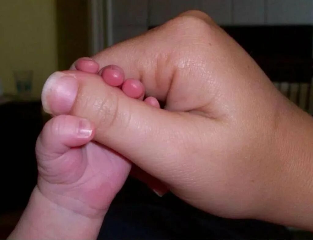 Почему пальцы короткие. Большие пальцы на руках широкие. Маленький ноготь на большом пальце. Широкий ноготь на большом пальце.