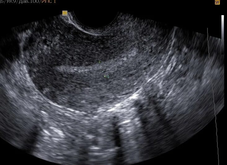 Гравидарный эндометрий на УЗИ. Гравидарный эндометрий УЗИ при беременности. Гравидарная гиперплазия эндометрия. Эндометрий с плодным яйцом. Эндометрий нечеткий