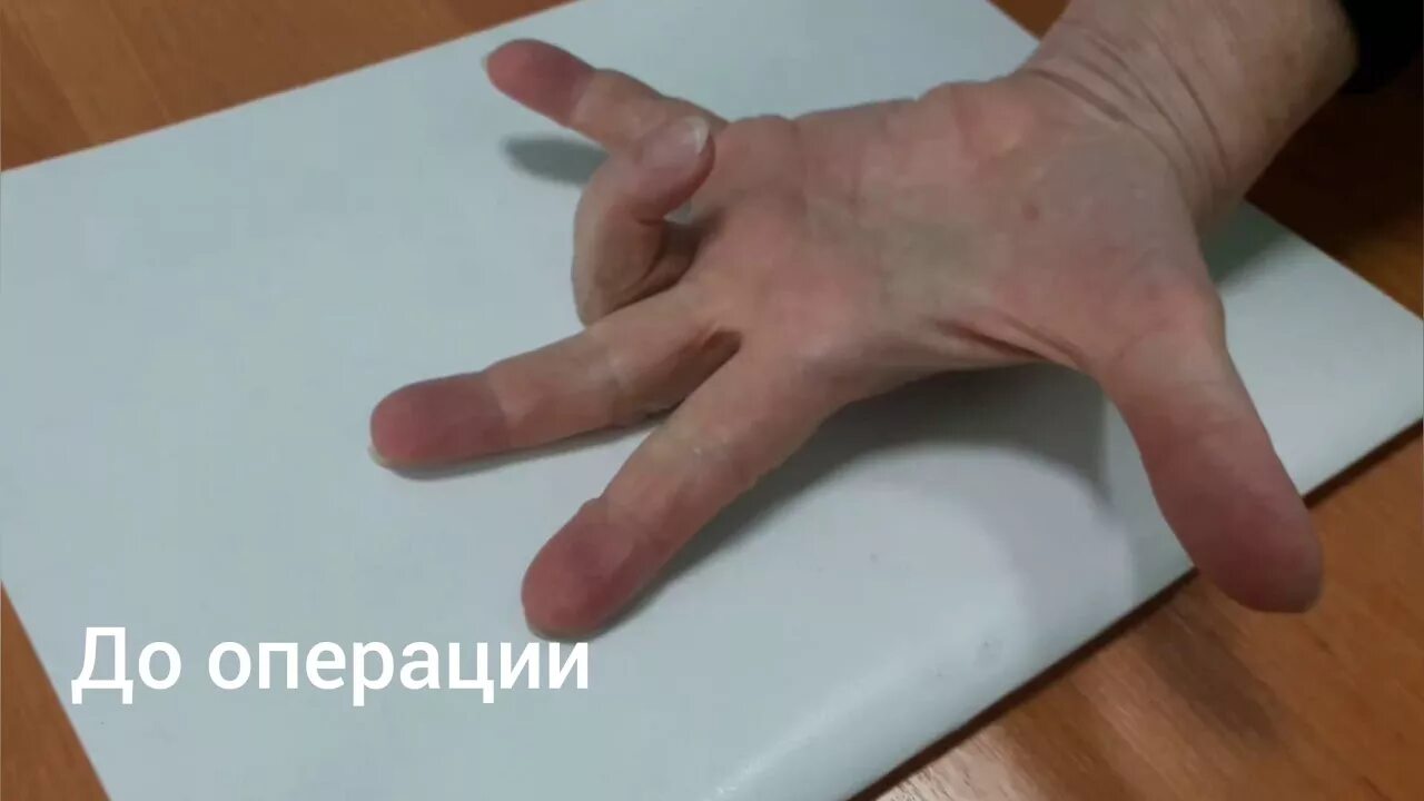 Болезнь нотта форум. Стенозирующий лигаментит нотта. лигаментит 1 пальца-синдром нотта. болезнь нотта щелкающий палец.