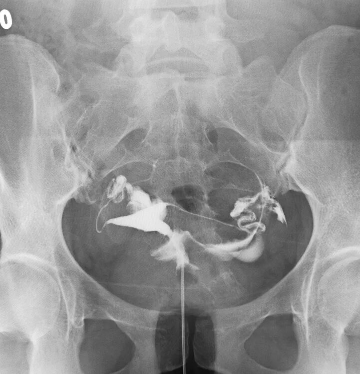 Сдать гсг. Сдать гсг. Сдать гсг. Катетер на гсг маточных труб. Гистеросальпингография полип.