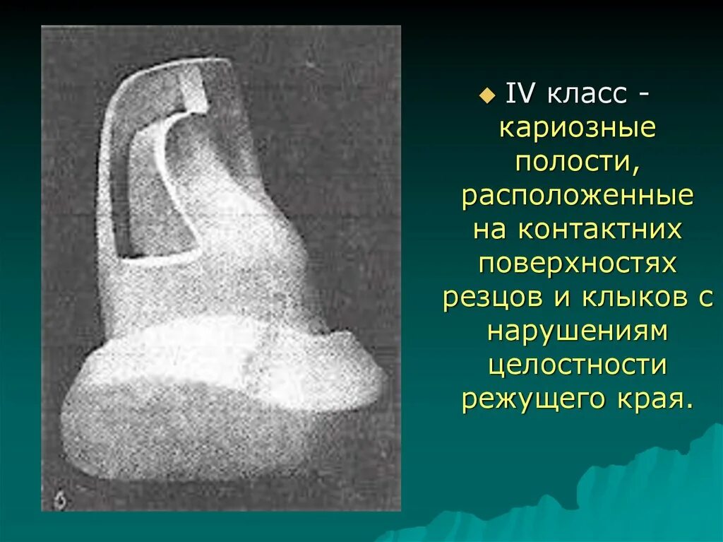 Iv класс блэка. Препарирование полостей 4 класса по блэку. препарирование кариозной полости. полость 4 класса по блэку. полости 3 и 4 класса по блэку.
