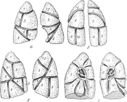 10 сегментов легких. Сегментарное строение легкого. Сегментарное строение легкого схема. Сегментарное строение легких рентген. 7 Сегмент правого легкого.
