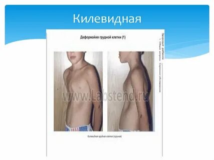 Грудная клетка у детей 2 года