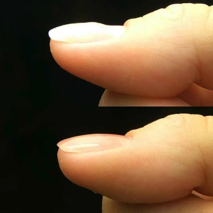 Вмятина на ногте большого пальца. Ямка на большом ногте руки. Ониходистрофия борозды. Ямка на большом ногте руки. Ямка на большом ногте руки.