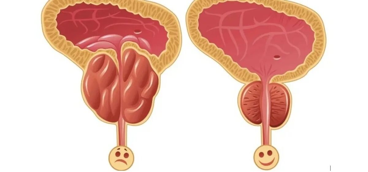 Воспаленная аденома простаты. Острый и хронический простатит. Простата рисунок.