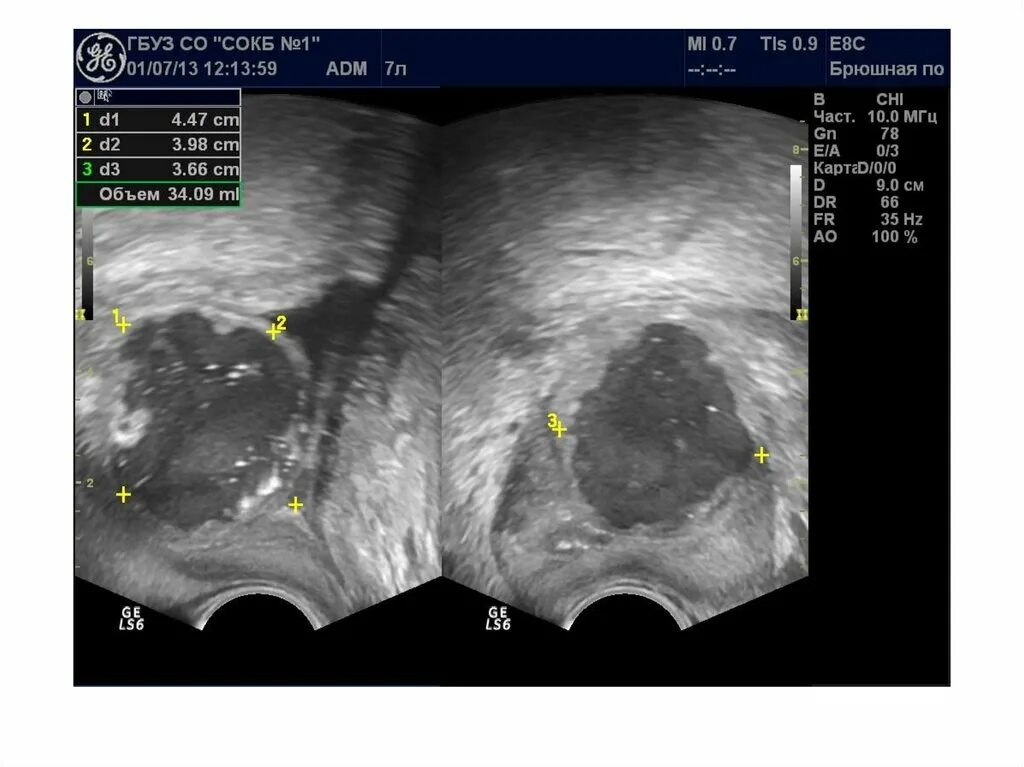 УЗИ предстательной железы Изранов. УЗИ предстательной железы простатит. УЗИ доброкачественная гиперплазия предстательной железы. УЗИ трузи предстательной железы. Симптомы фиброза у мужчин