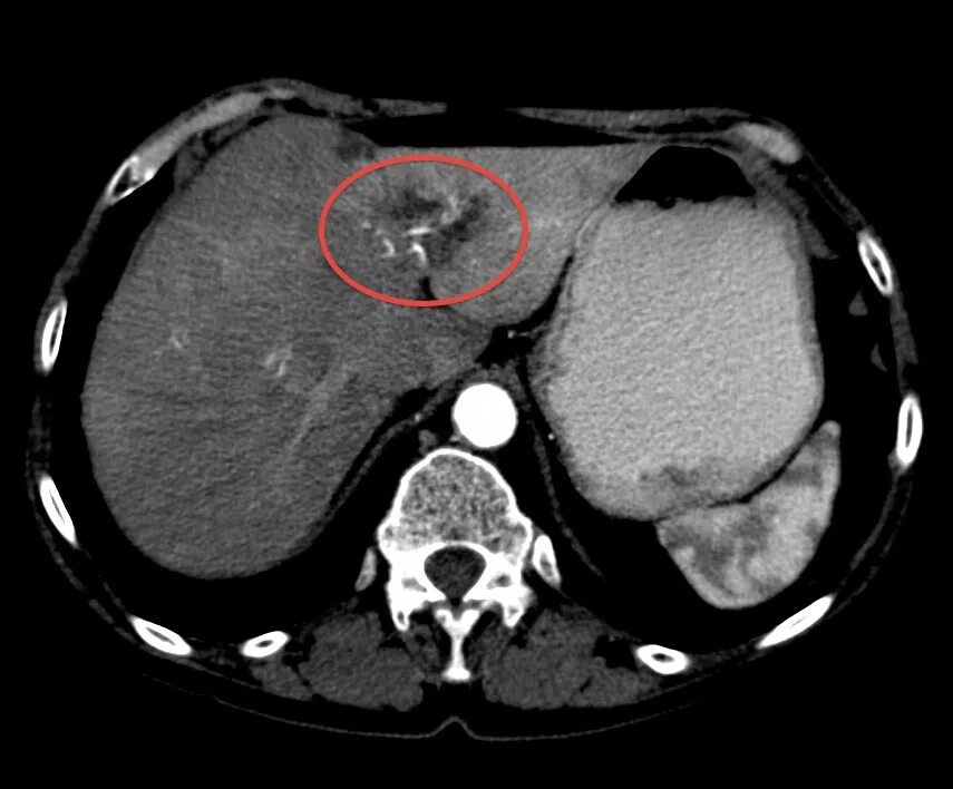 Гиперваскулярные метастазы печени кт. Гиперваскулярные образования печени на кт. Гиподенсный очаг печени кт. Гиповаскулярное образование в печени на кт что это. Гиподенсивное образование в печени