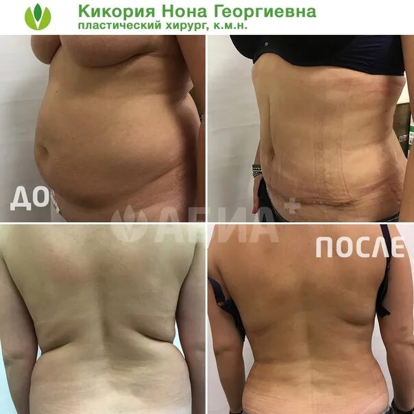 Через месяц после абдоминопластики