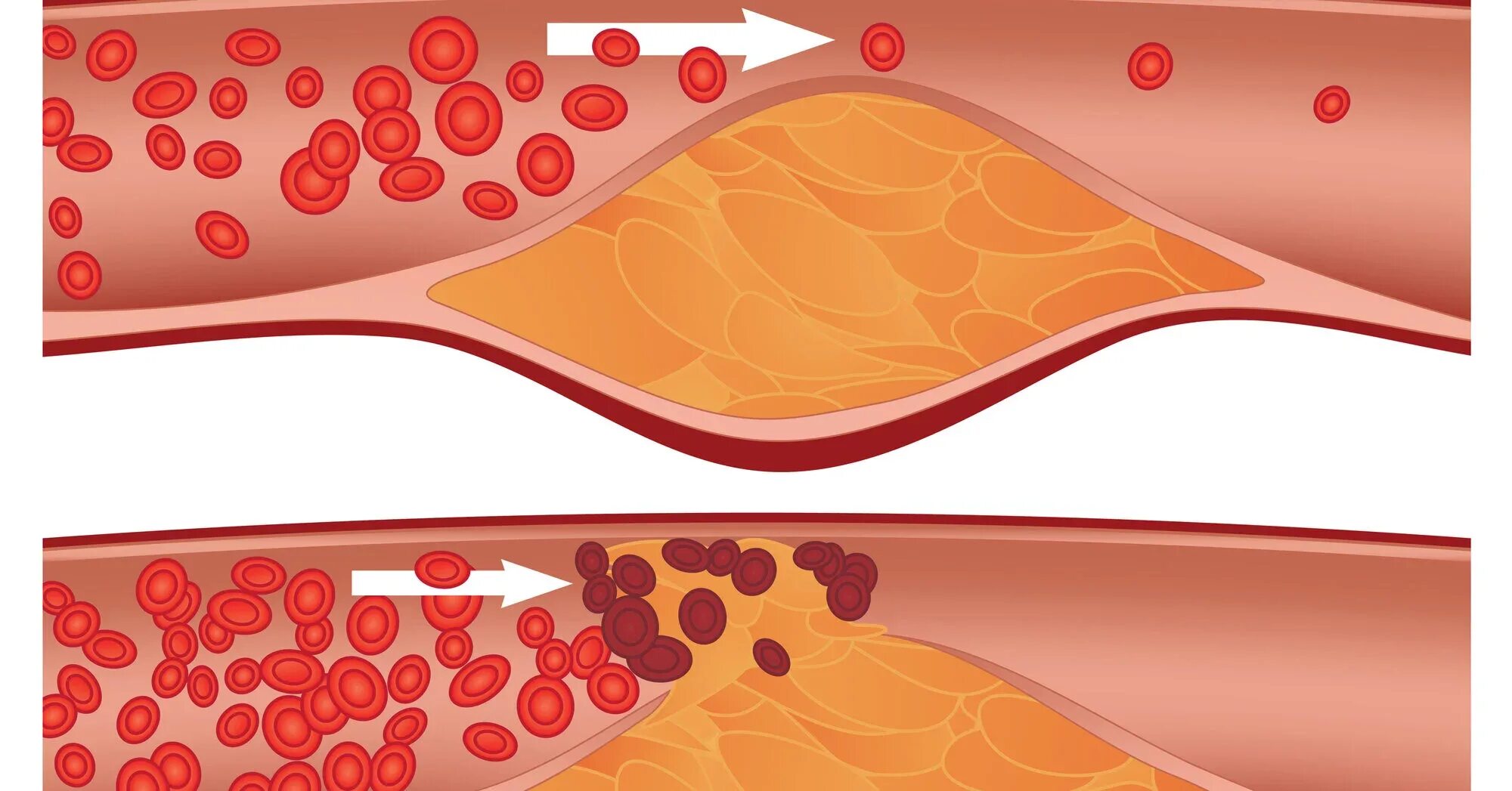 Чем чистить холестериновые бляшки. Гиперхолестеринемия и гипертриглицеридемия. Атеросклероз липосклероз. Гиперхолестеринемия дислипидемия. Атеросклеротические бляшки в сосудах.