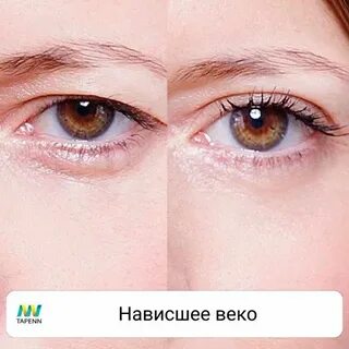Почему веки стали больше
