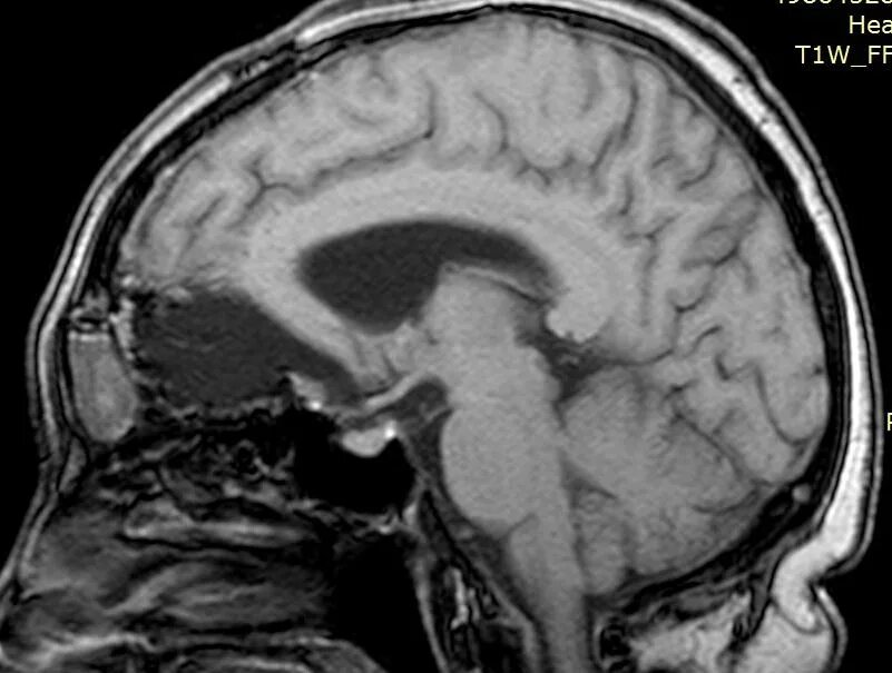 После операции менингиомы головного мозга. Менингиома передней черепной ямки. Менингиома кости черепа.