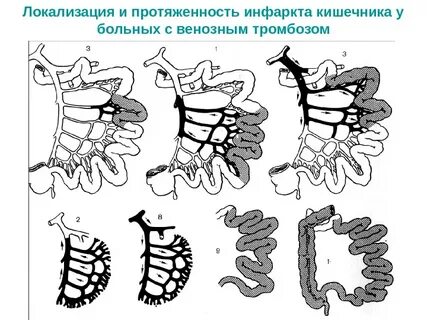 Желудочно кишечный инфаркт