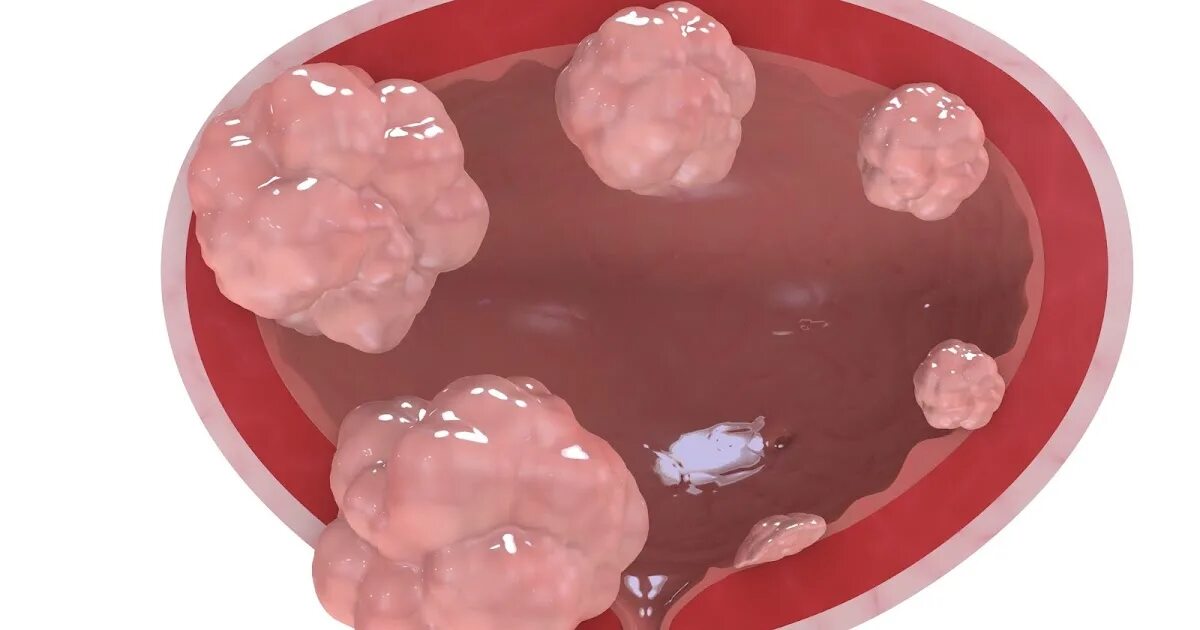 Злокачественная опухоль мочевого пузыря. Доброкачественная и злокачественная опухоль мочевого пузыря. Раковая опухоль мочевого пузыря. Новообразование в мочевом. Рак мочевого отзывы