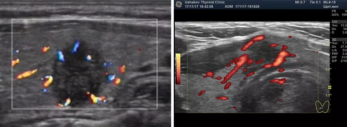 Перинодулярный кровоток узла щитовидной. Допплерометрия щитовидной железы. Цветное допплеровское картирование щитовидной железы. УЗИ щитовидной железы с допплерографией. Перинодулярный кровоток что это