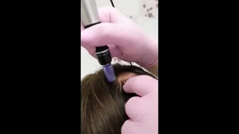 Фракционная мезотерапия головы