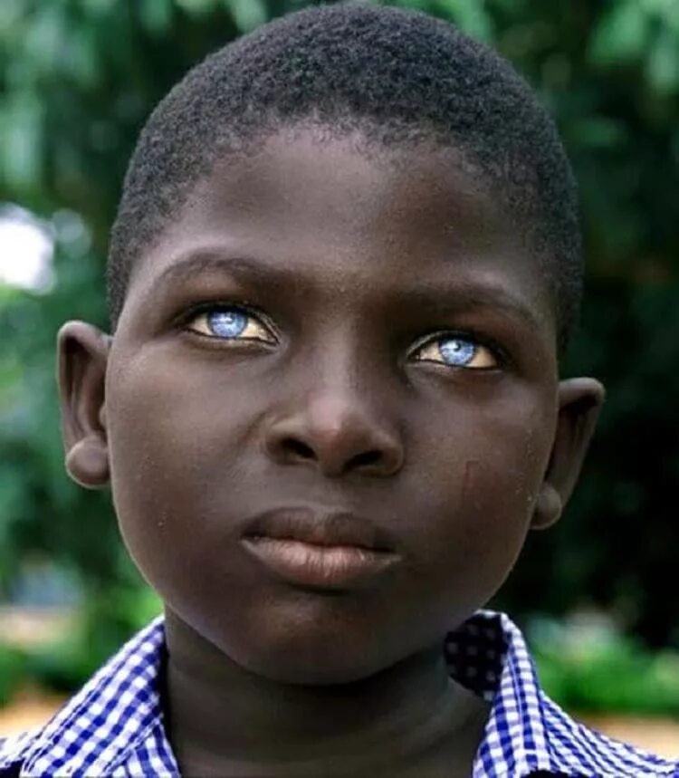Глаза темнокожих. Негроидная раса Мулаты. Метисы с негроидной расой. Альбинос негроидной расы. Альбинизм 1а у негроидной расы.