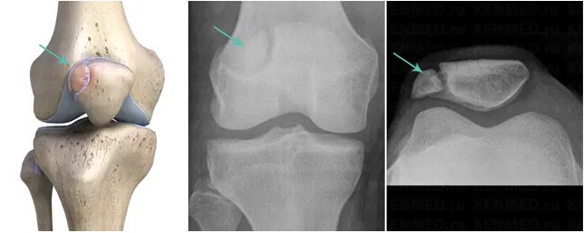Дольчатый надколенник. Дольчатый надколенник рентген. Перелом надколенника дольчатый надколенник. Дольчатый надколенник мрт. Перелом надколенника операции