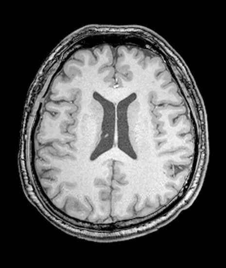 Асимметрия боковых желудочков головного мозга показатели. Асимметрия желудочков у новорожденных. Асимметрия желудочков у новорожденных. Асимметрия желудочков у новорожденных. Асимметрия желудочков у новорожденных.