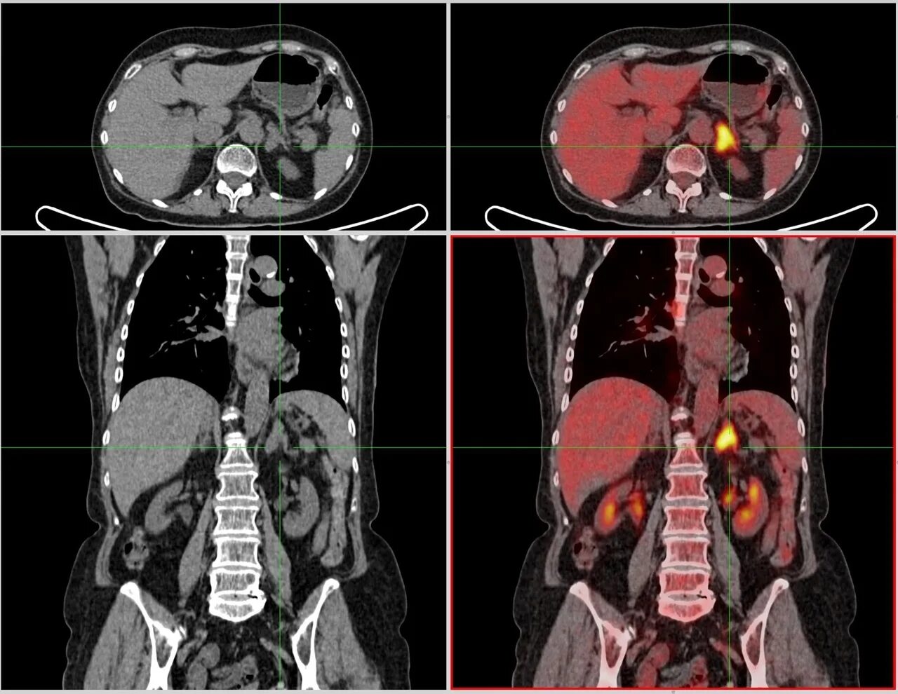 Позитрон-эмиссионная томография. Позитронно-эмиссионная томография метастазы. Позитронно эмиссионная томография почек. Н 3 кт