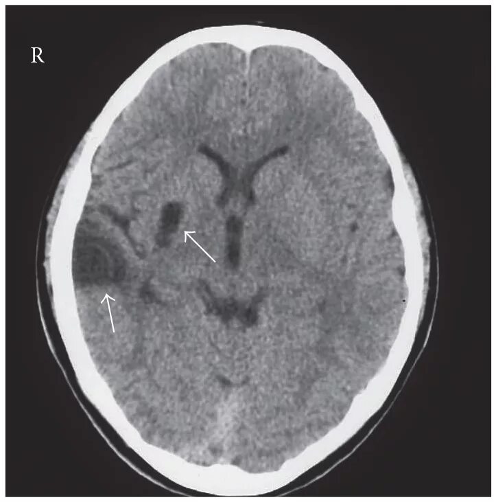 Лейкоэнцефалит. Инфаркт головного мозга кт. лейкоэнцефалит кт головного мозга. правая сма головного мозга на кт. мрт инфаркт лобной доли.