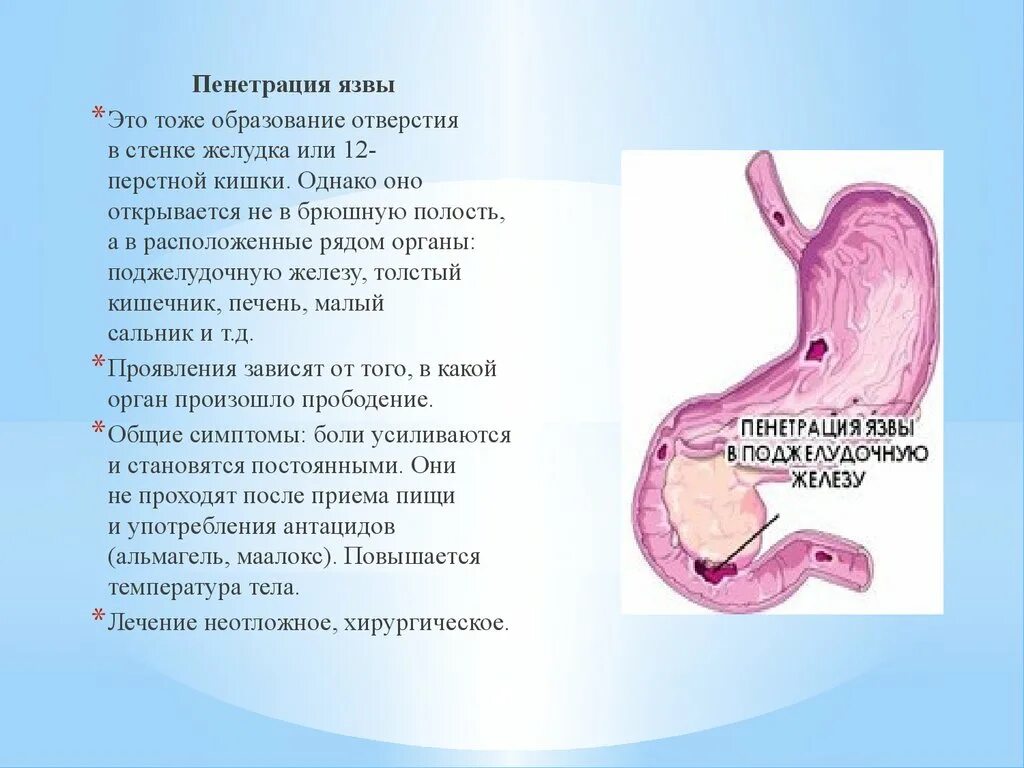 Осложненная язва. Пенетрация язвы 12 перстной кишки. Пенетрация язвенной болезни желудка. * Пенетрация язвы 12-перстной поджелудочную железу. Язвенная болезнь желудка ДПК осложненная.