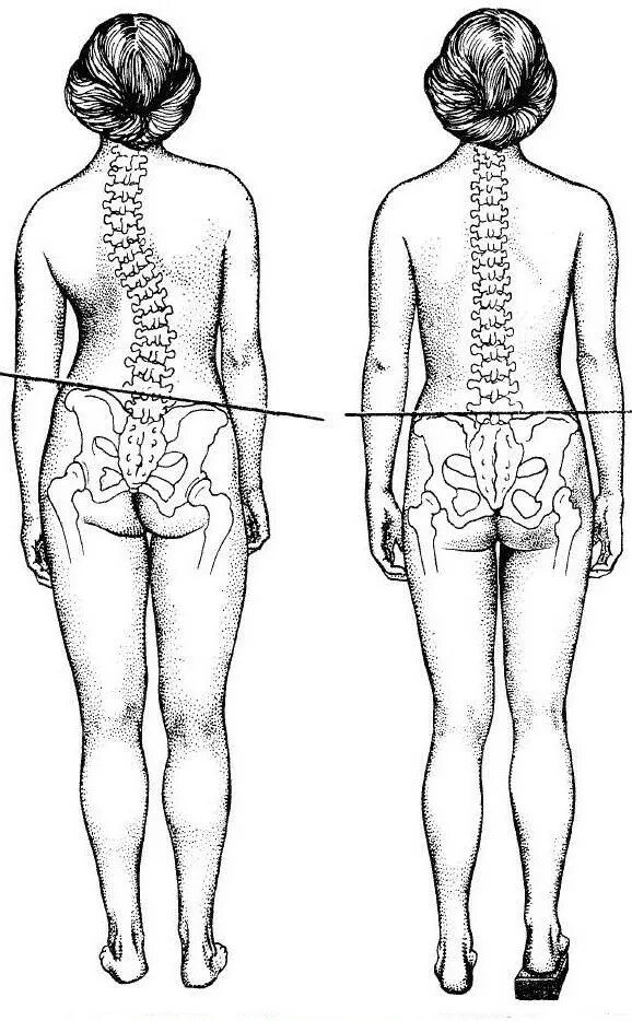 Болит спина у копчика. Искривление позвоночника сколиоз. Искривление позвоночника перекос таза. Перекос позвоночника сколиоз. Перекос (смещение) костей таза.