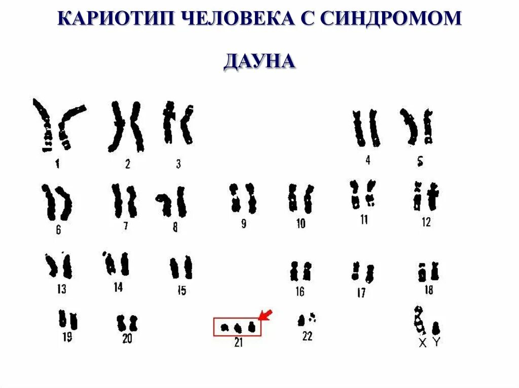 Хромосомный набор человека с синдромом дауна. 24 хромосомы у человека. Как выглядит хромосома человека. Количество групп сцепления хромосом. 24 хромосомы у человека.