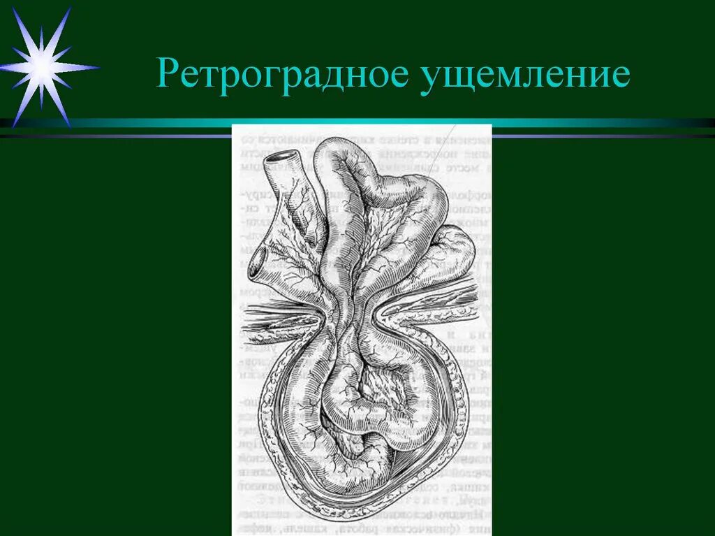 Ущемленная грыжа помощь. Пристеночное ущемление грыжи. Ретроградное ущемление грыжи. Ретроградное w образное ущемление.