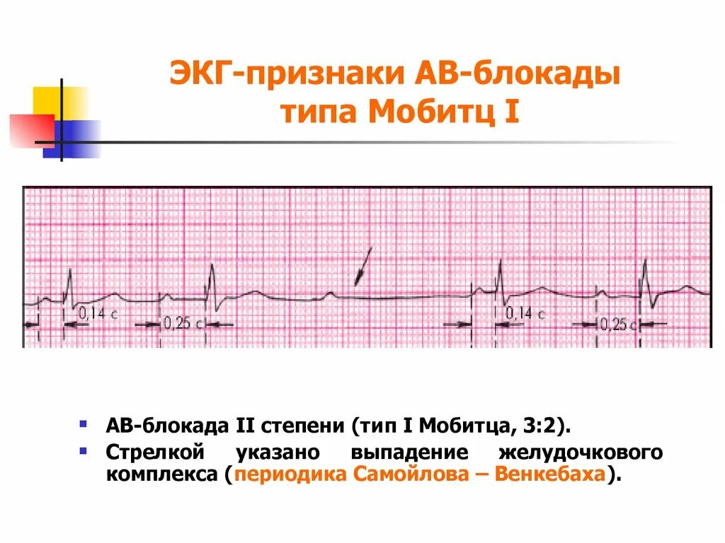 Комплекс блокада. ЭКГ признаки АВ блокады 2 степени Мобитц 1. Av блокада 2 степени Мобитц 2 на ЭКГ. АВ блокада 2 степени Мобитц 1 на ЭКГ. АВ-блокады II степени II типа (Мобитц II),.