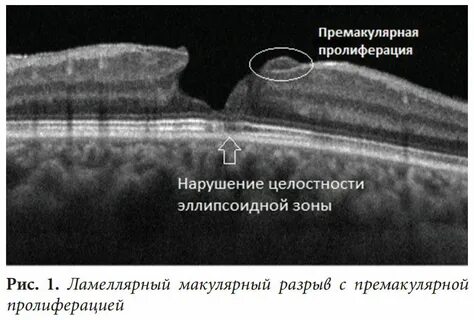 Макула разрыв операция