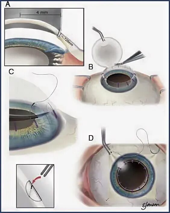 Можно пересадить глаз человеку. Можно пересадить глаз человеку. Трансплантация зрительного нерва. Аллоплант для сетчатки глаза. Можно пересадить глаз человеку.