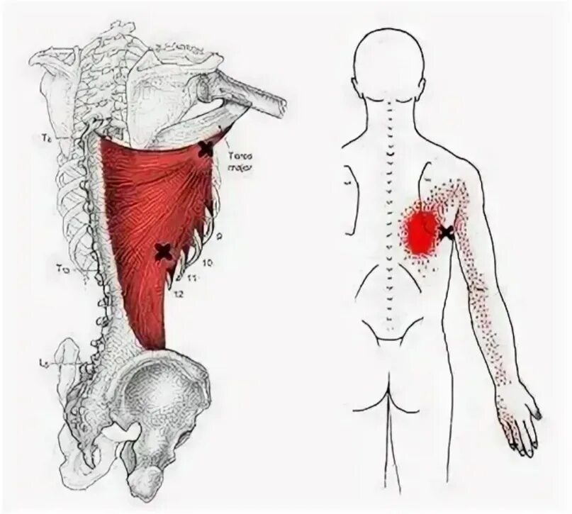 Триггерные точки поясницы. Триггерные точки широчайшей мышцы спины. Триггерные точки в мышцах спины. Мышцы боли триггерные точки. Боль в спине триггерные точки.
