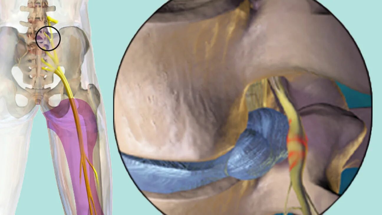 Ишиас - защемление седалищного нерва. Защемление седалищного нерва s1. Ишиас тазобедренного сустава симптомы. Радикулопатия седалищного нерва. Несдавленный