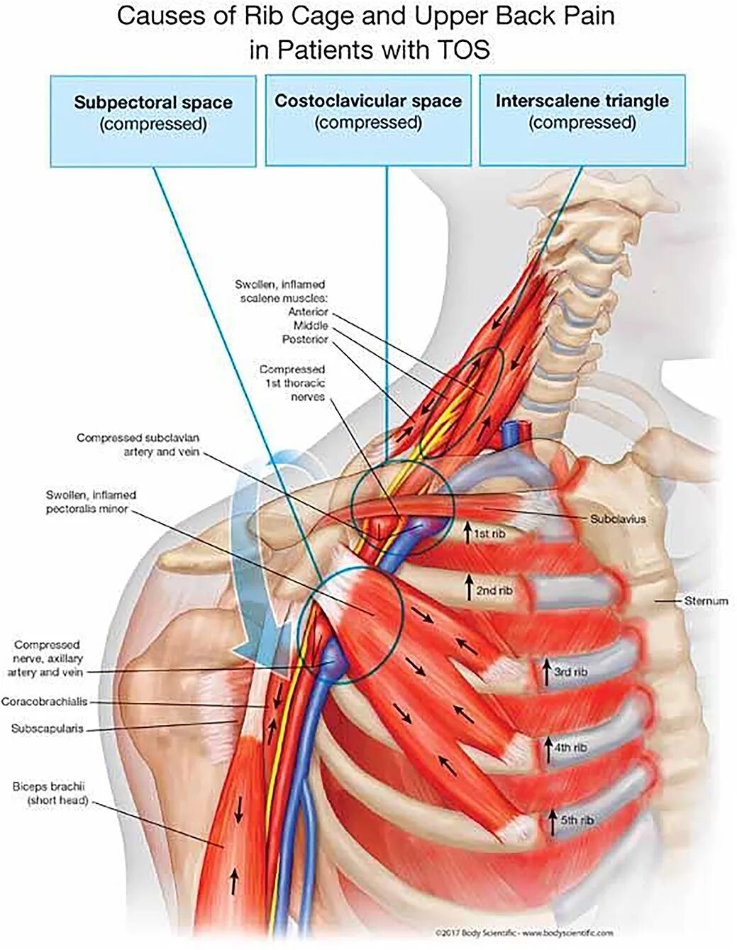 Синдром верхней грудной апертуры. Синдром верхней апертуры грудной клетки. Синдром верхней апертуры грудной мышцы. Компрессионный синдром верхней апертуры грудной клетки.