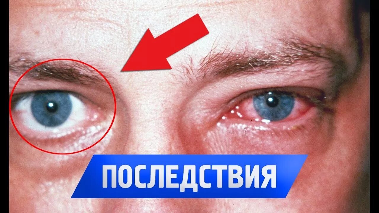 Что будет если не спать 10. Глаза человека который не спал. глаза человека который долго не спал. глаза если долго не спать.
