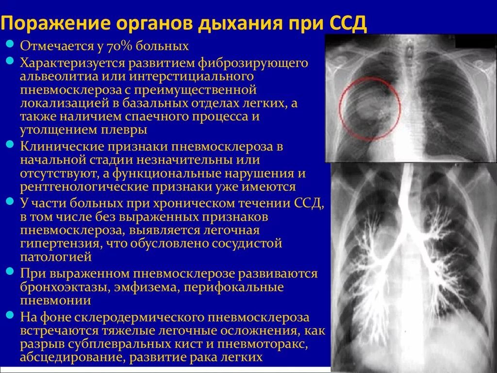 Изменения базальных отделов легких. Поражение легких при системной склеродермии. Рентгенограмма легких при системной склеродермии. Поражение лёгких при системной склеродермии. Поражение органов при склеродермии.